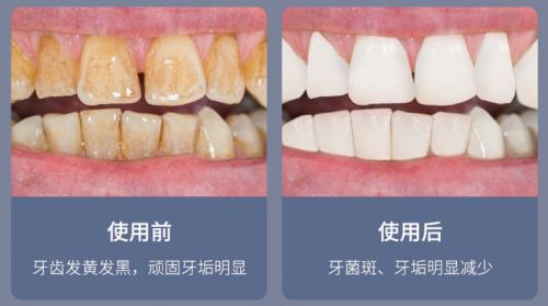 告別刷牙盲區(qū)，現(xiàn)代口腔護理新選擇 為何它能解決你的深層困擾